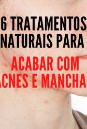 6 TRATAMENTOS NATURAIS PARA ACABAR COM A